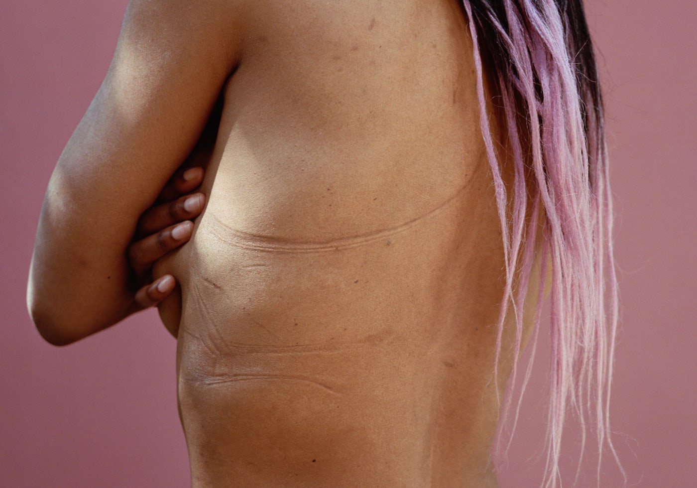 Image showing a womans back with with string marks from an incorrectly sized bra.